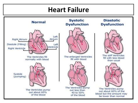 left ventricular dysfunction reviews.